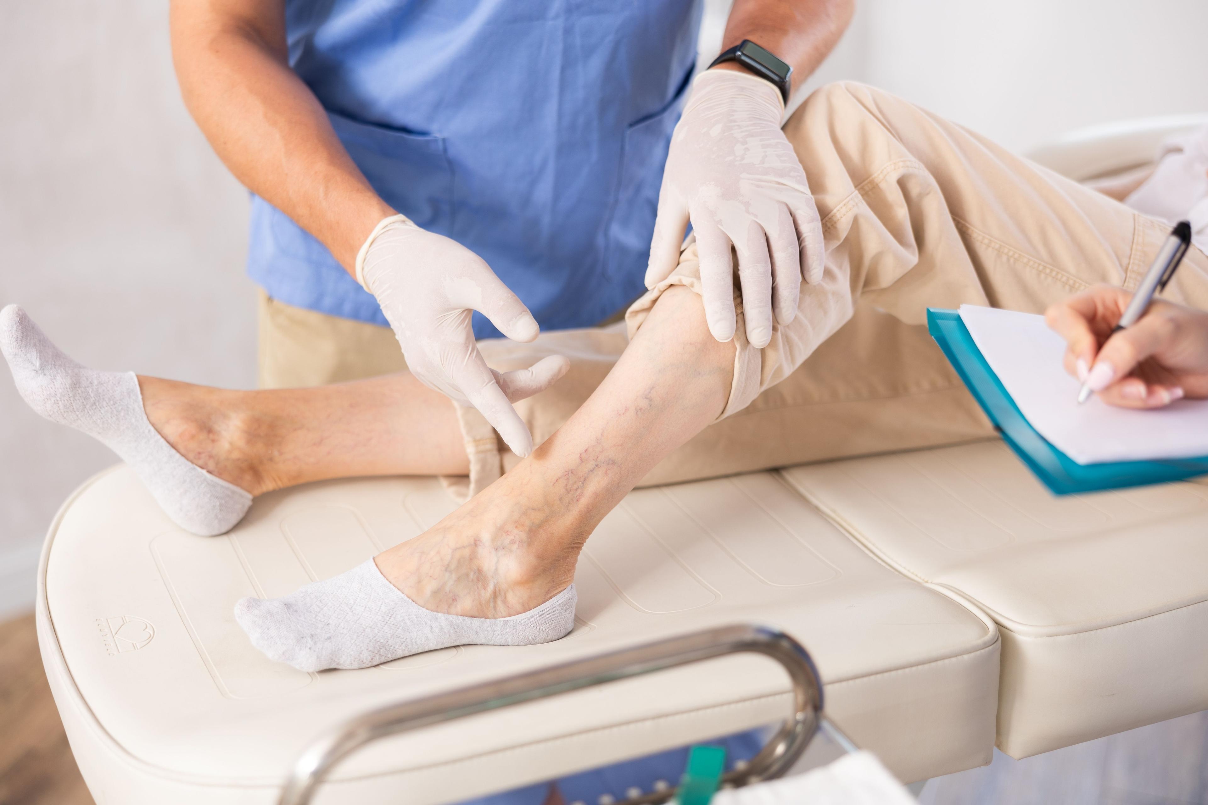 Signes d’insuffisance veineuse : que faire ?