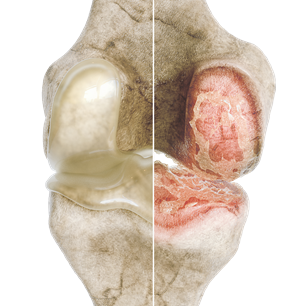 Knee cartilage osteoarthritis comparison