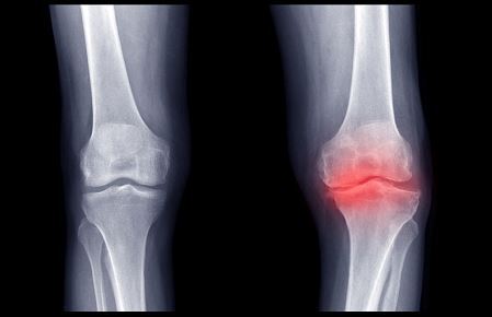 Knee x-ray for gonarthrosis diagnosis