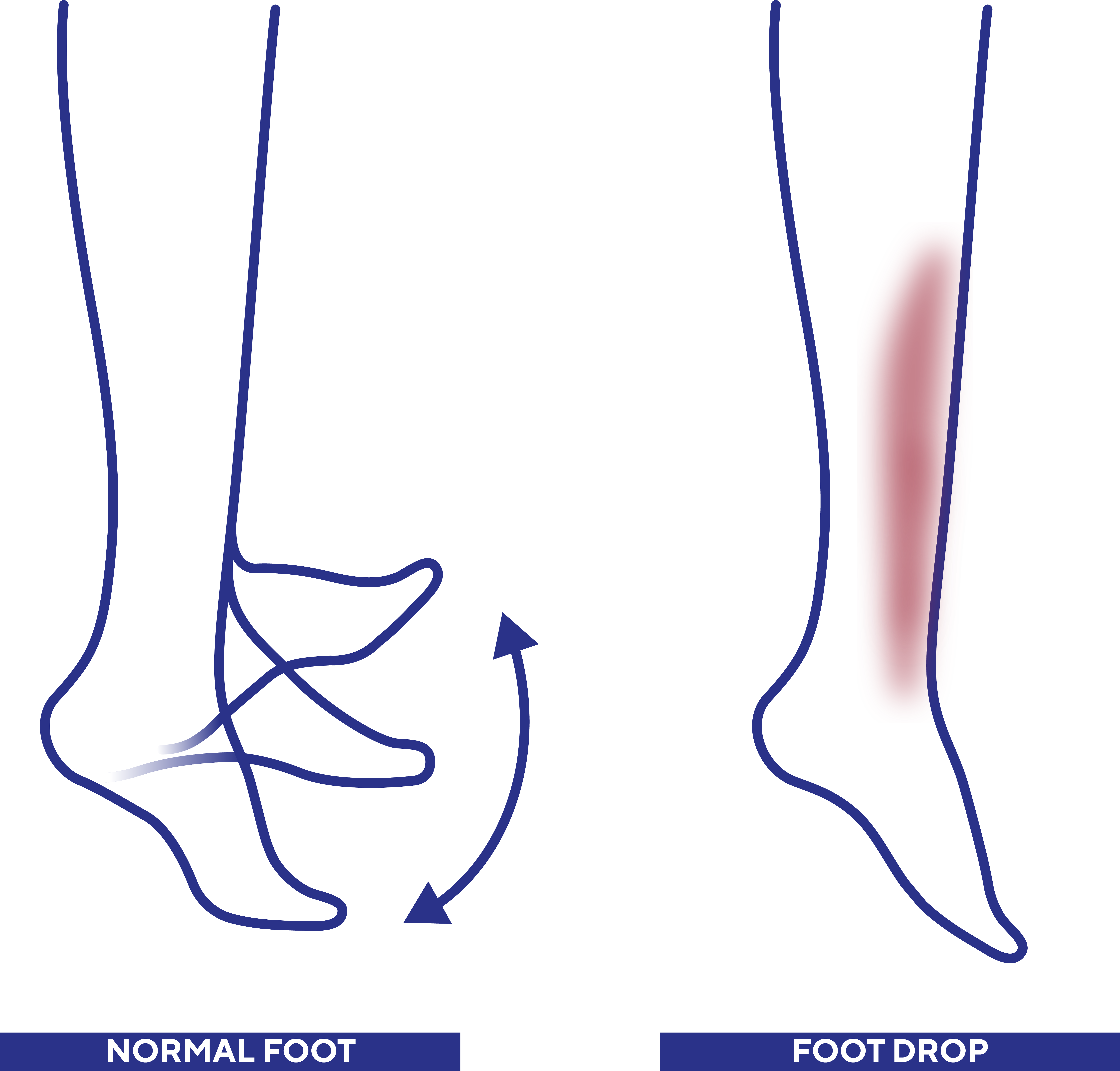 Foot Drop - Walking Problems - Symptoms - Neurological - What We
