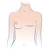 Mastectomy